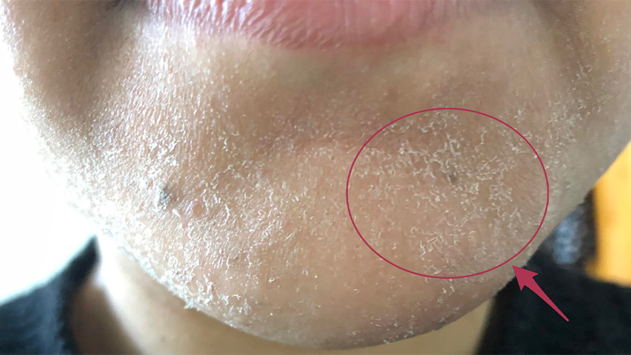 Post-wax skin irritation