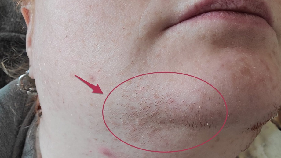 Insulin resistance and PCOS facial hair